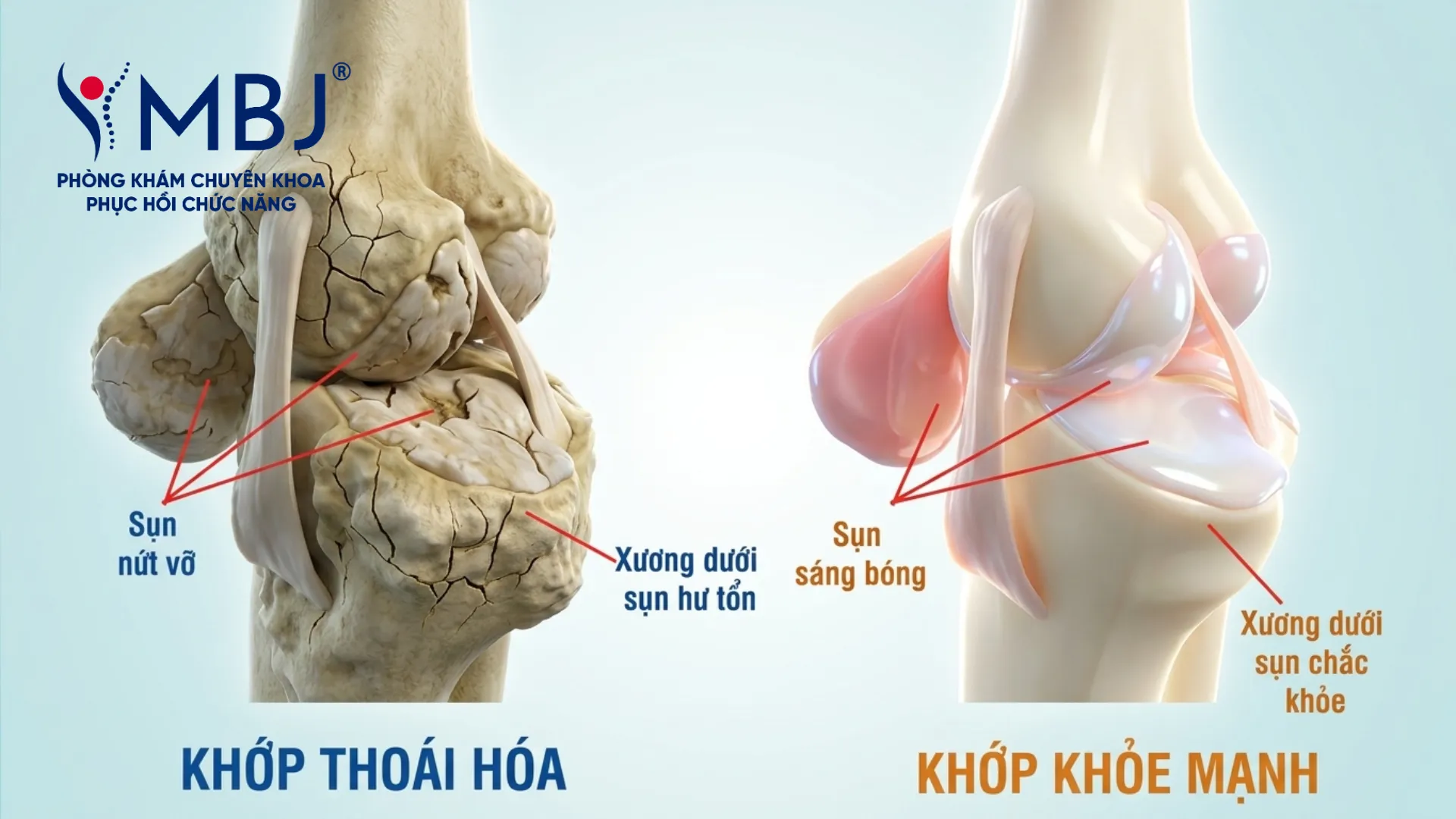 Laser Therapy điều trị bệnh thoái hoá khớp