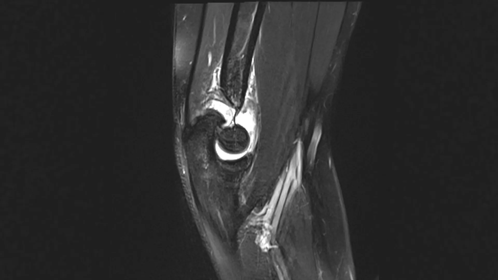 Kết quả chụp MRI viêm khớp dạng thấp
