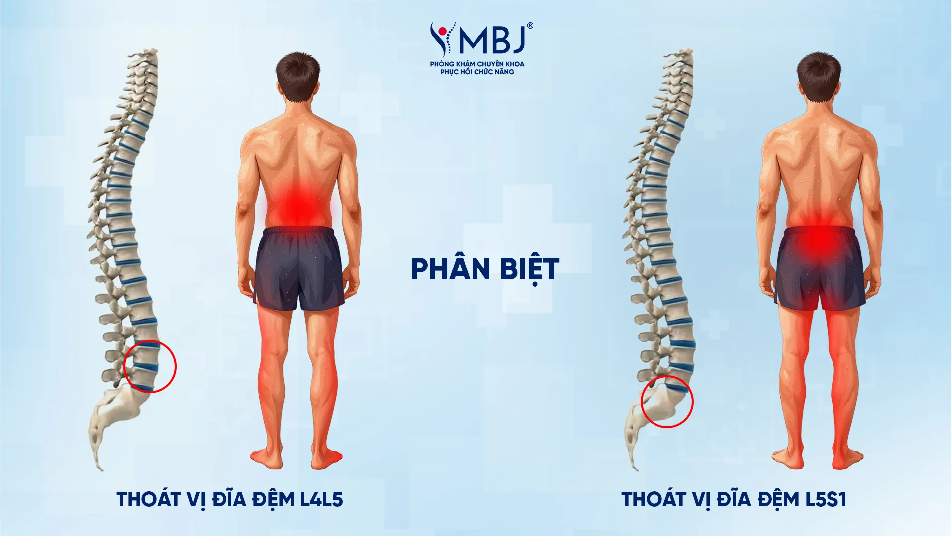 Phân biệt thoát vị đĩa đệm L4L5 và L5S1