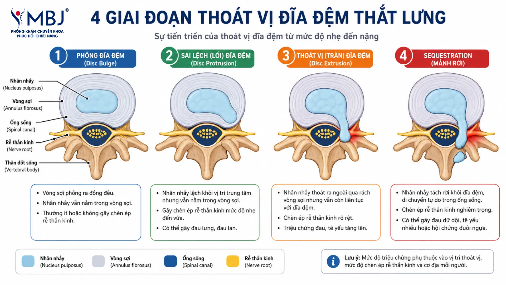 Sơ đồ 4 mức độ thoát vị đĩa đệm từ phồng đĩa đến di trú nhân nhầy
