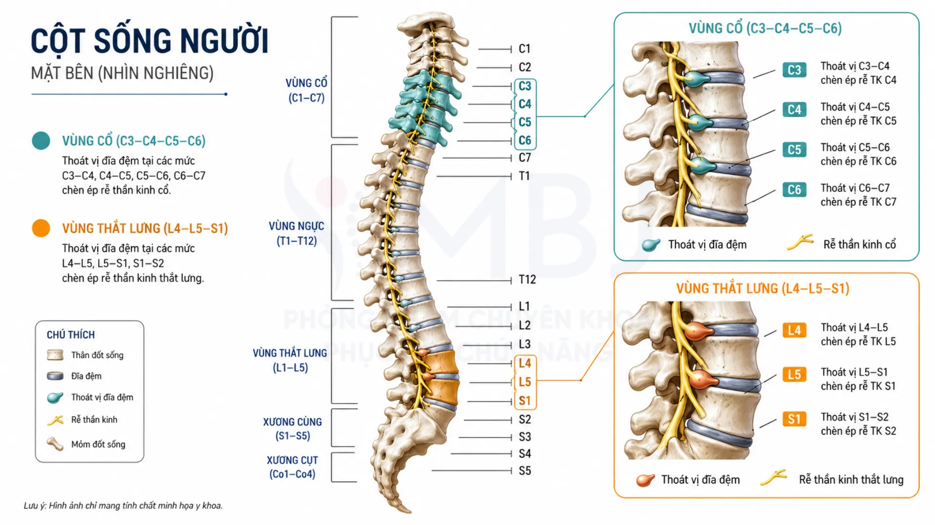 Sơ đồ cột sống người chỉ rõ vị trí thoát vị đĩa đệm L4-L5-S1 vùng thắt lưng và C3-C4-C5-C6 vùng cổ