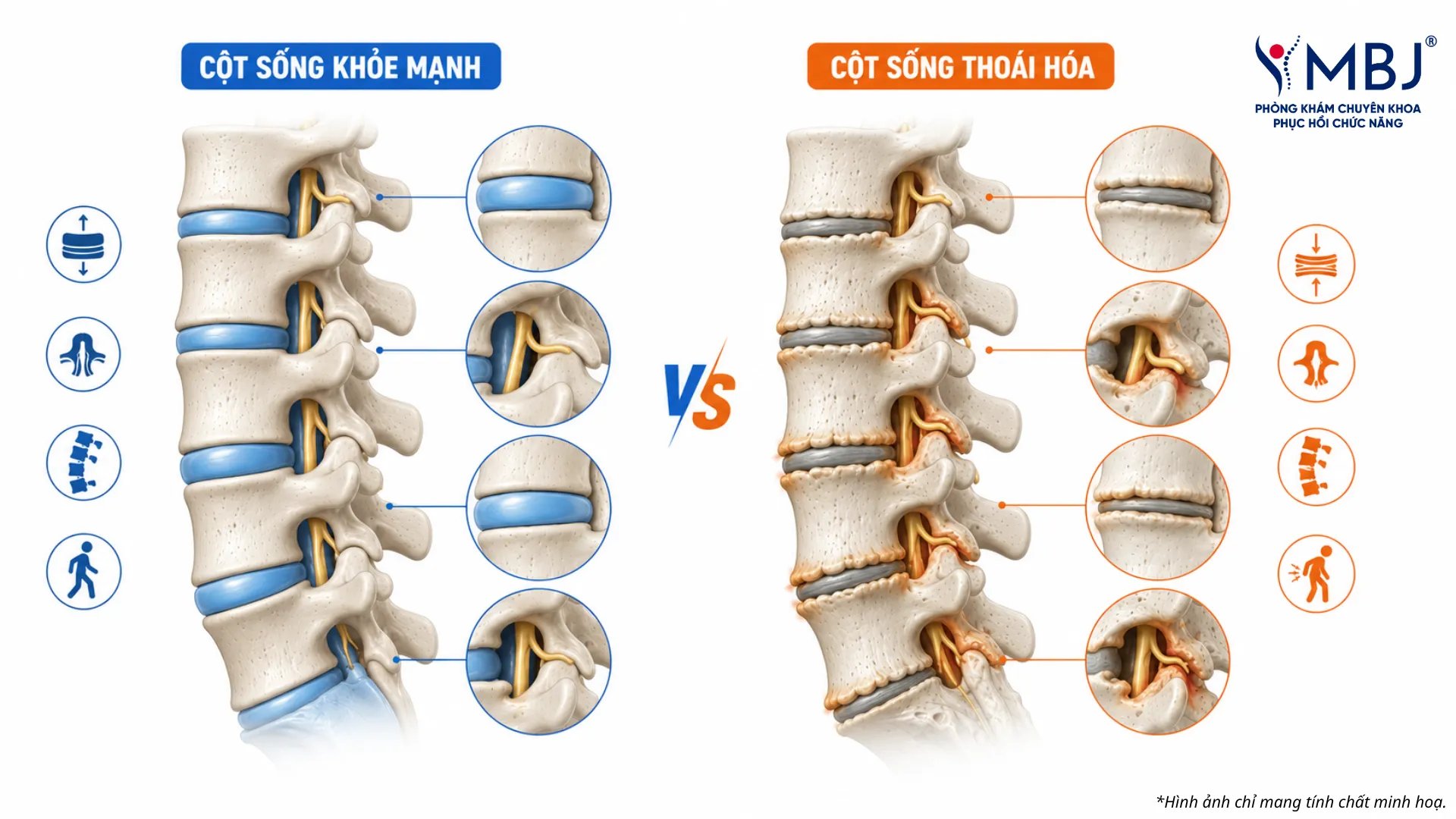 So sánh cột sống khỏe mạnh và cột sống thoái hóa: đĩa đệm bị mỏng, hẹp khoang gian đốt và hình thành gai xương
