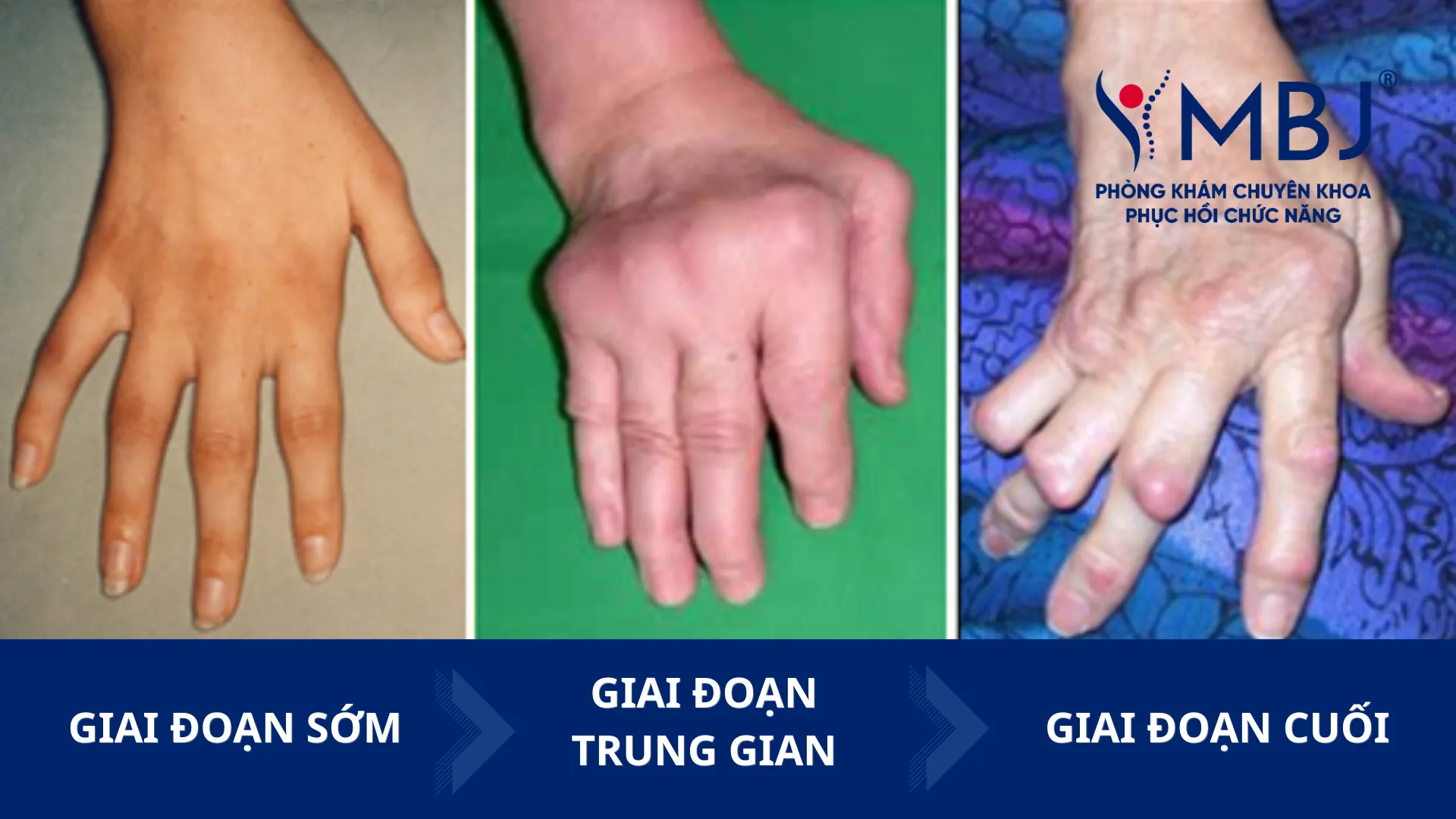 Sự nguy hiểm của viêm khớp nếu không điều trị
