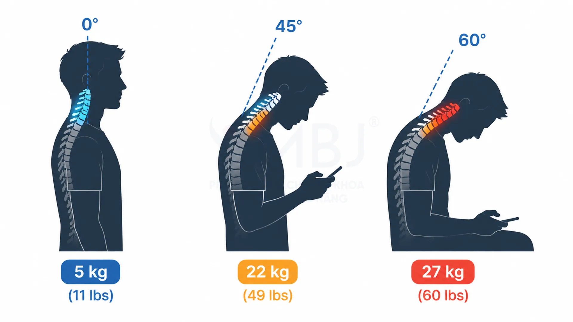Text neck: tư thế cúi cổ nhìn điện thoại làm tăng lực tác động lên đĩa đệm cột sống cổ