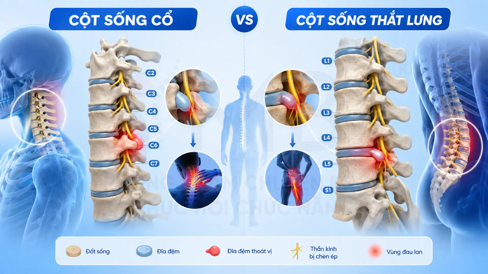 Thoát vị đĩa đệm cổ và thắt lưng