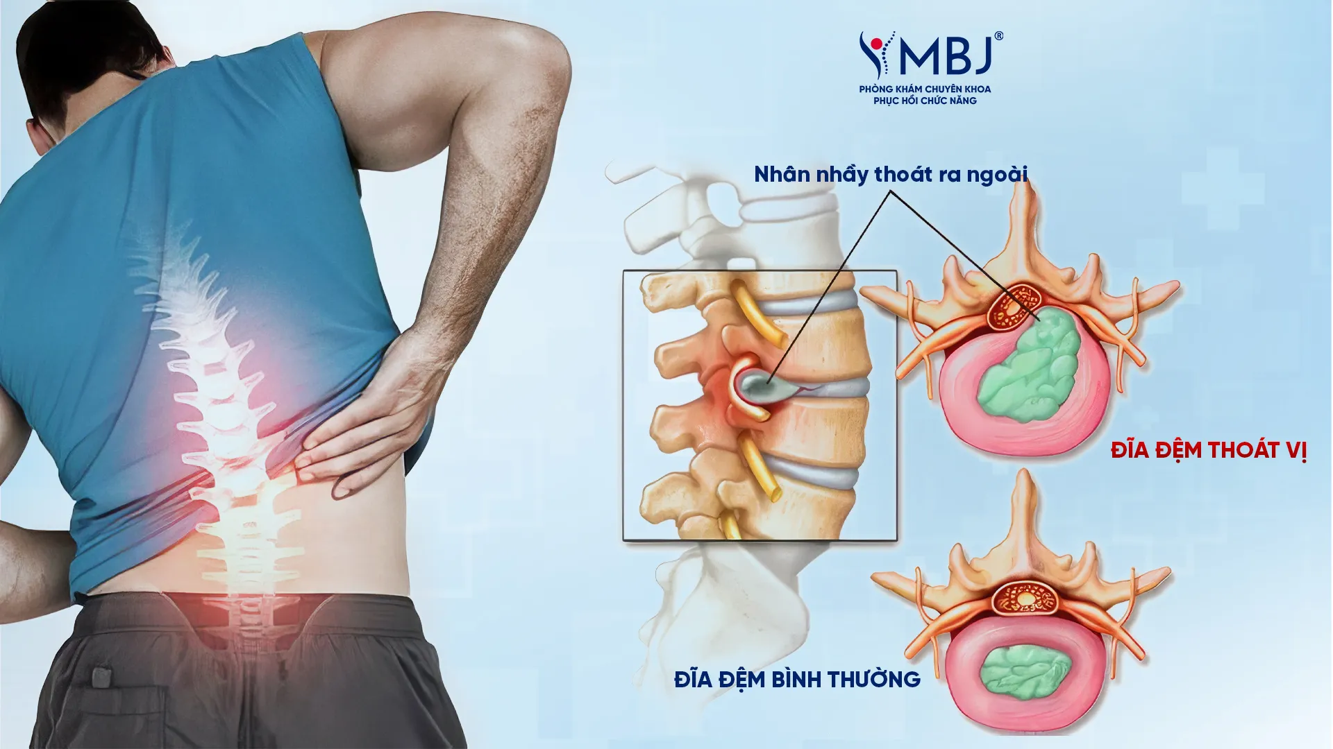 Tìm hiểu về thoát vị đĩa đệm L4L5