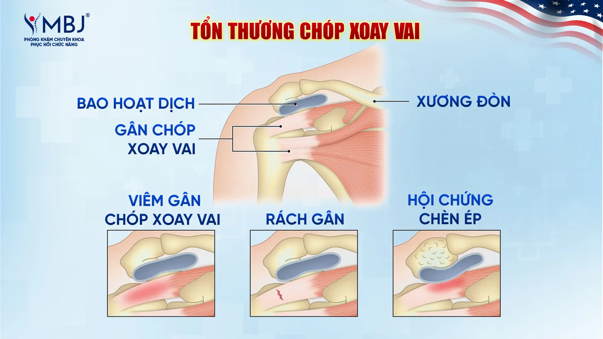 Tổn thương chóp xoay vai