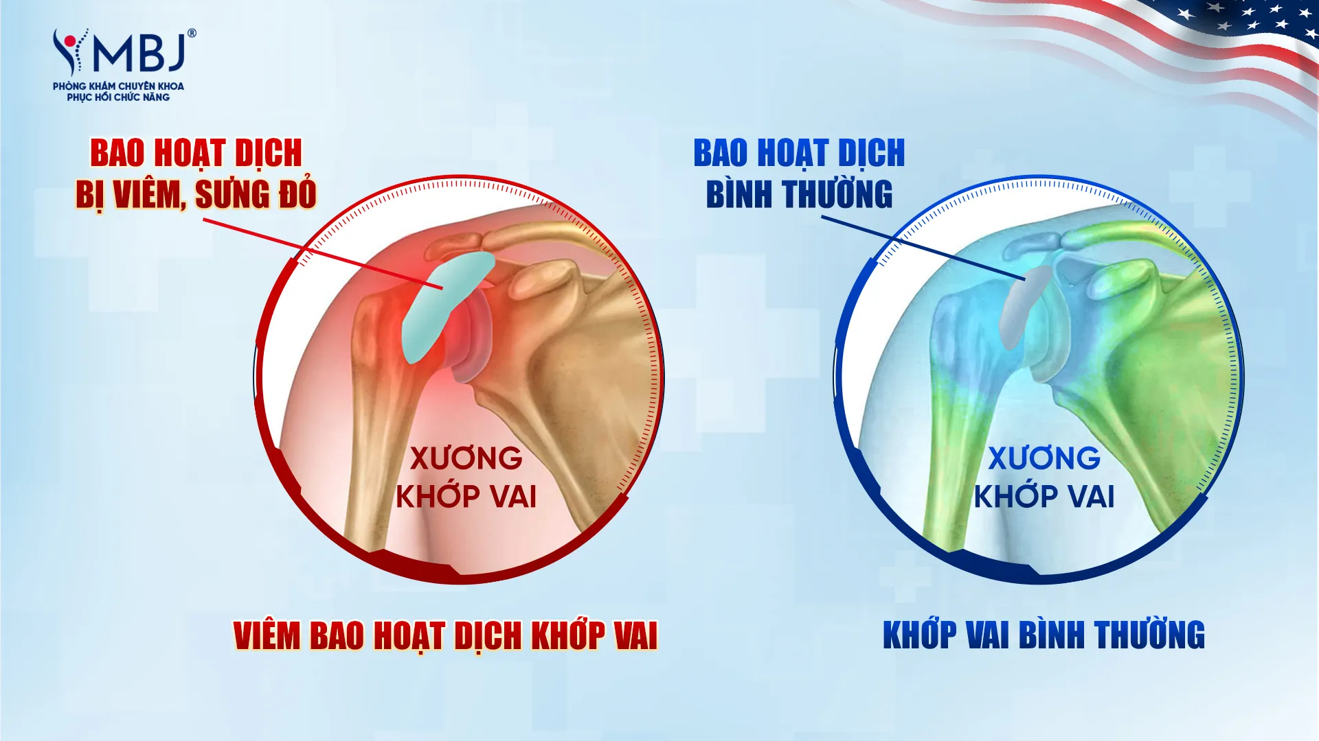 Viêm bao hoạt dịch khớp vai
