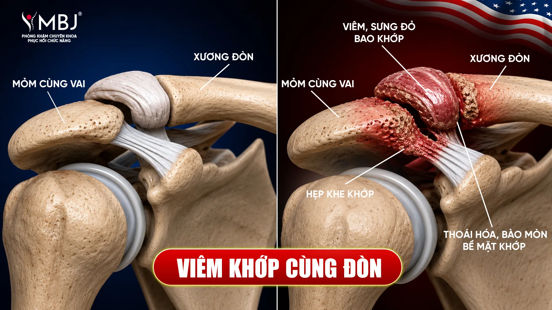 Viêm khớp cùng đòn