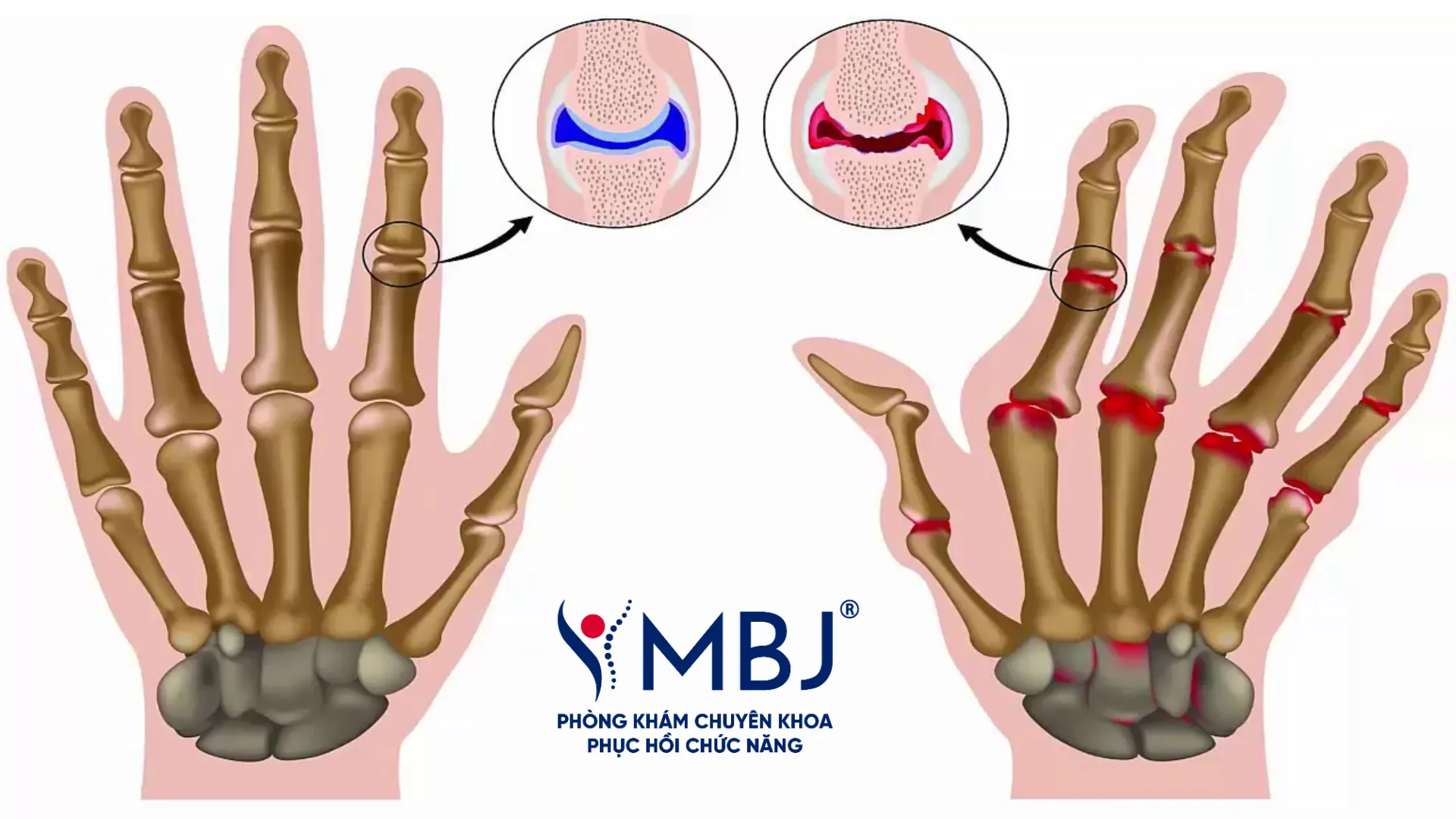 Viêm khớp dạng thấp ở bàn tay