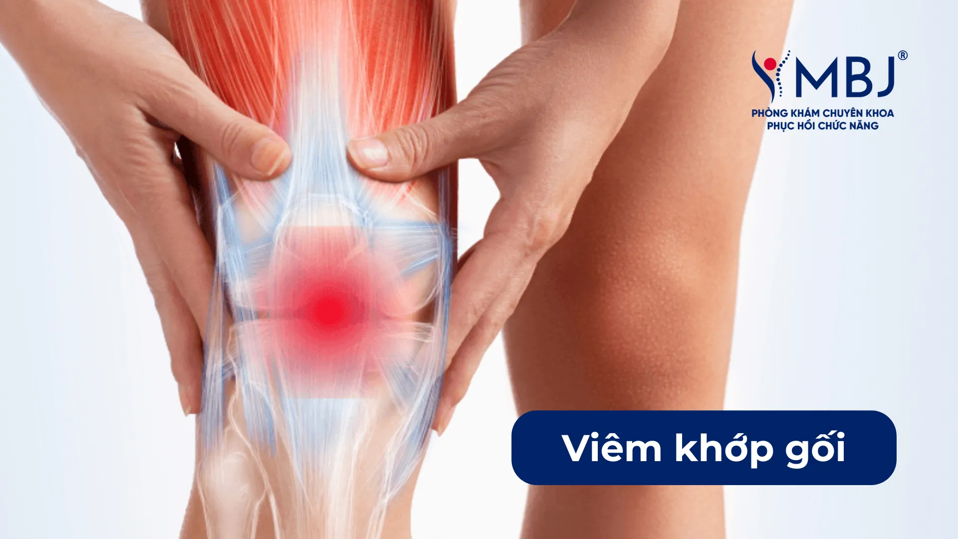 Viêm khớp gối là gì?