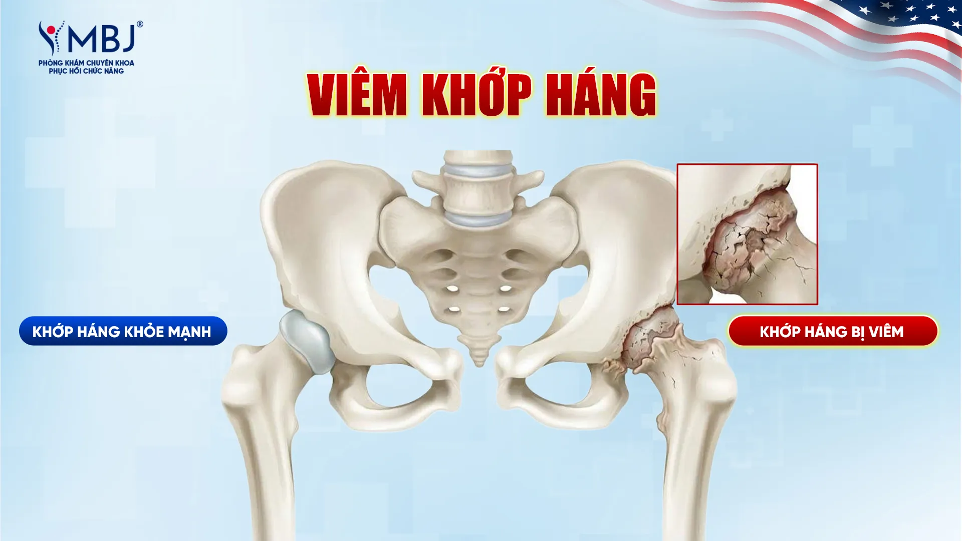 Viêm khớp háng là gì?