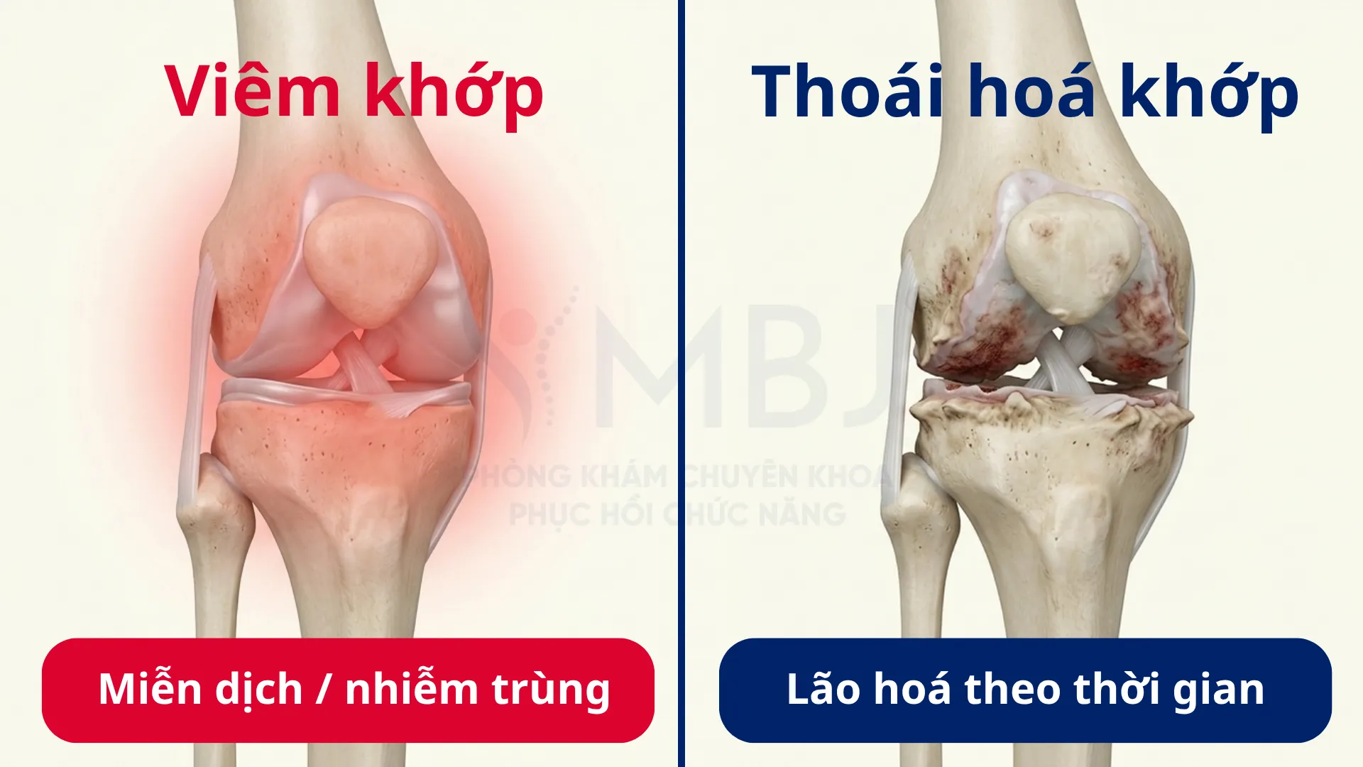 Viêm khớp vs thoái hoá khớp