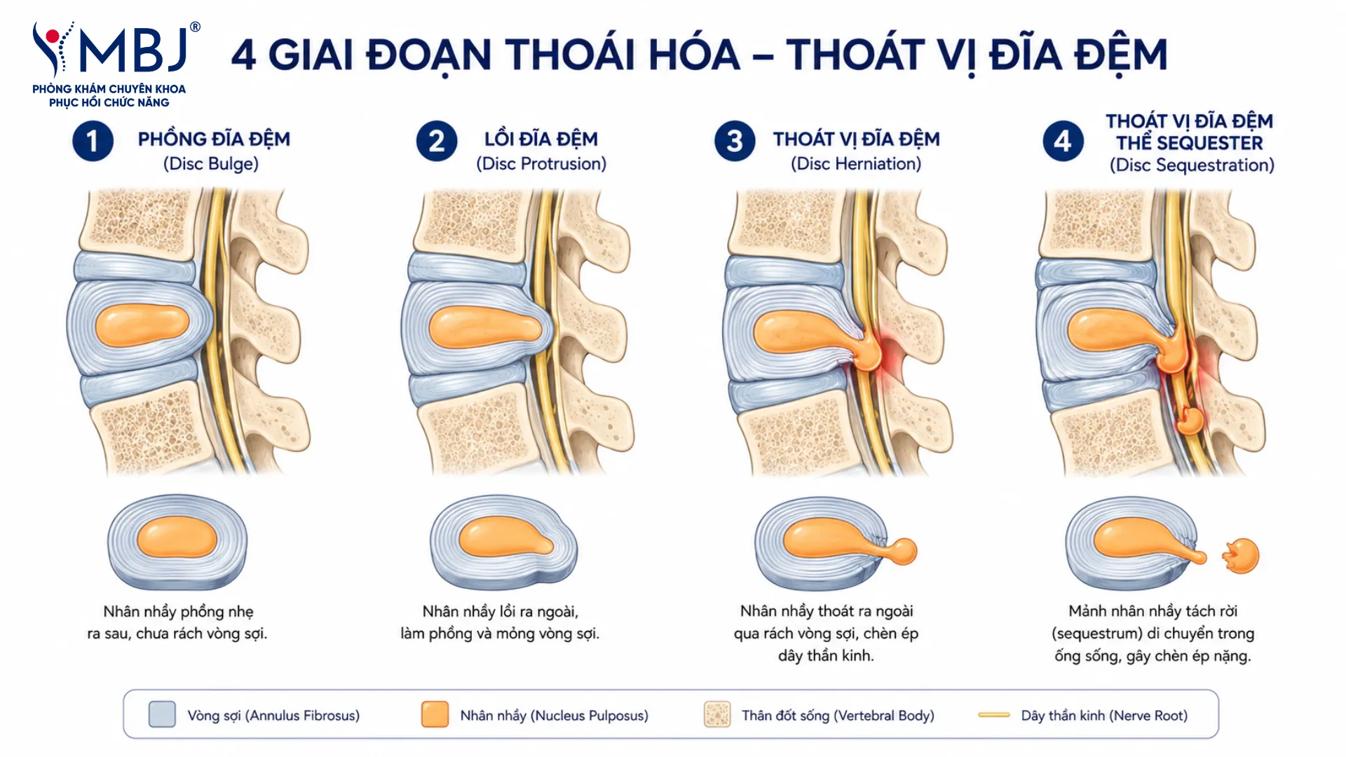 4 giai đoạn tổn thương đĩa đệm từ phình đến thoát vị tự do