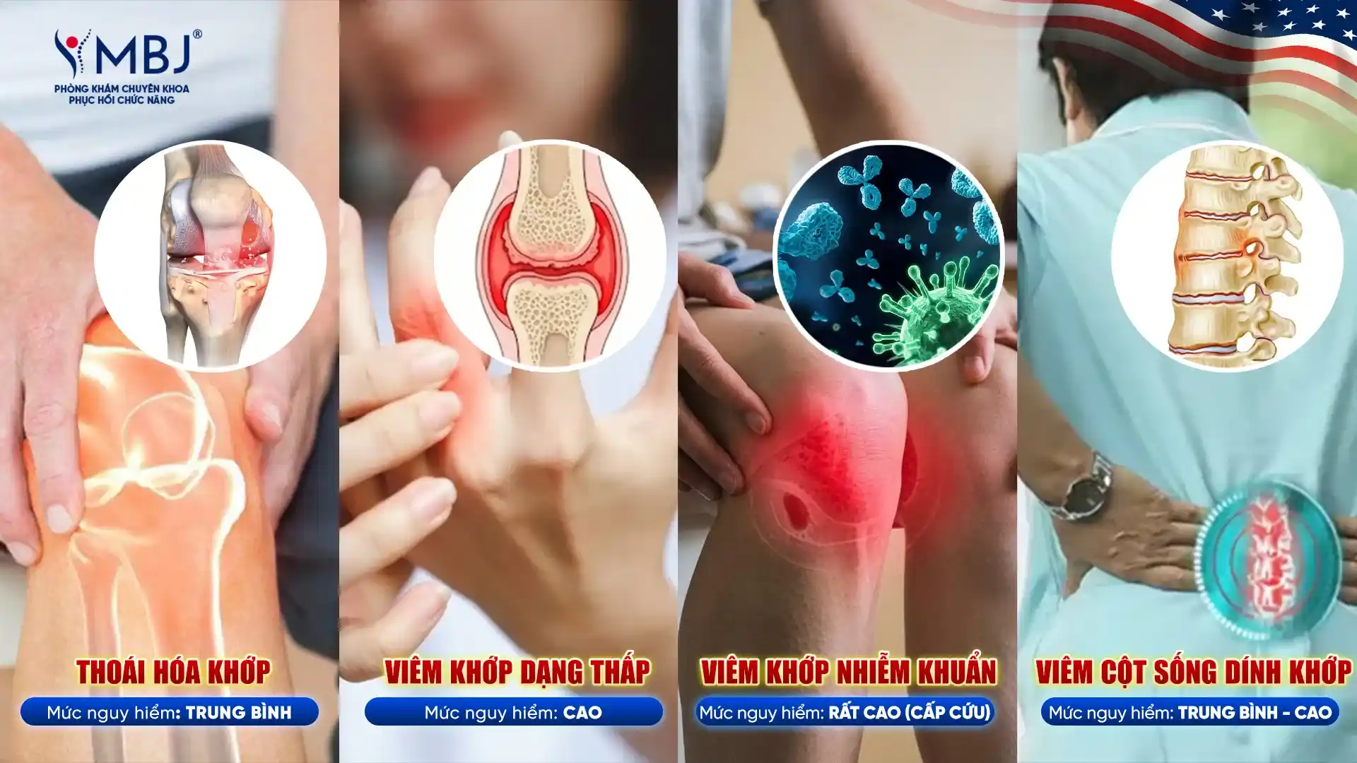 Các loại viêm khớp thường gặp