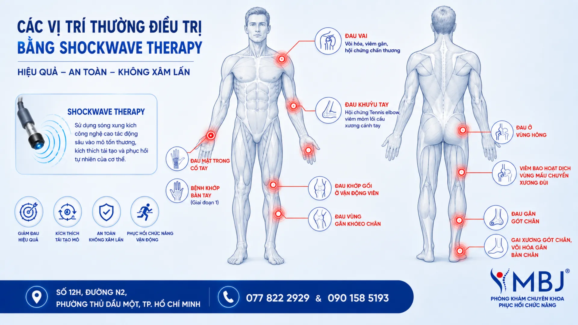Sơ đồ các vị trí điều trị shockwave therapy trên cơ thể người tại MBJ Bình Dương
