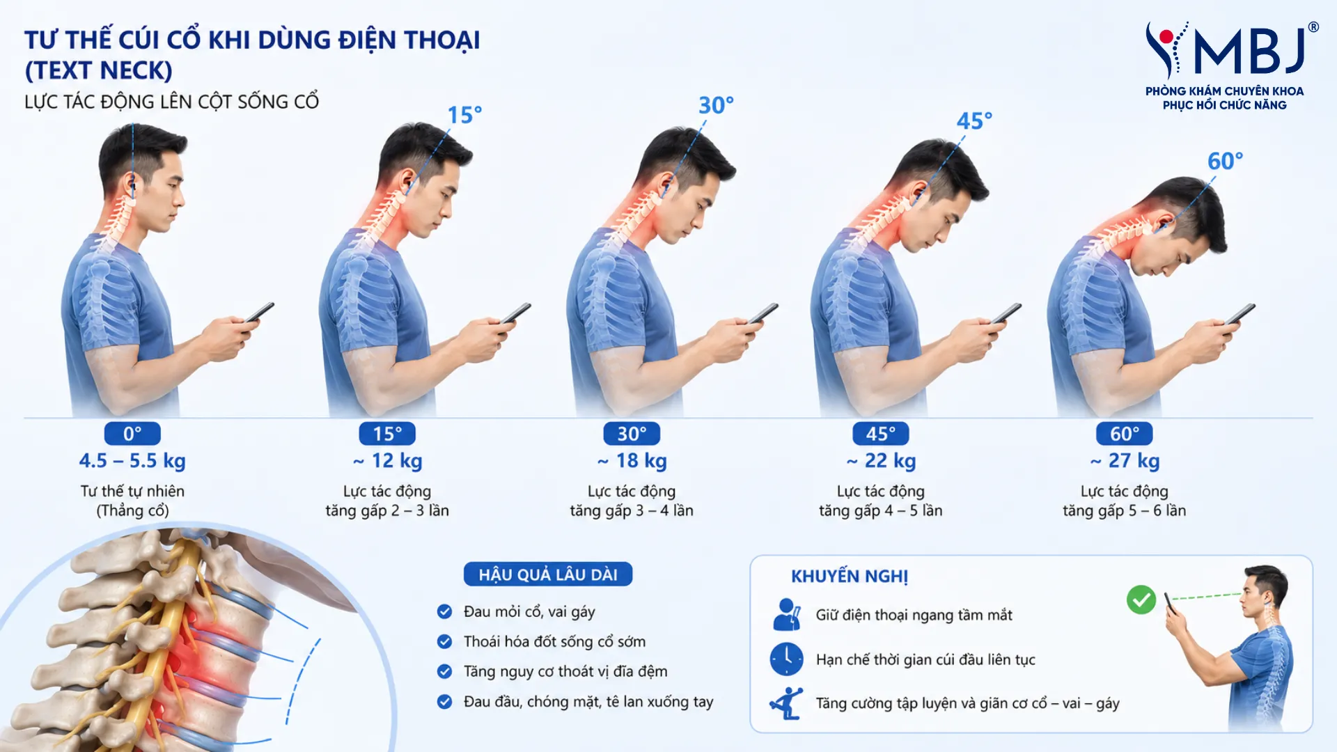 Cúi cổ nhìn điện thoại tác động rất lớn lên cột sống cổ