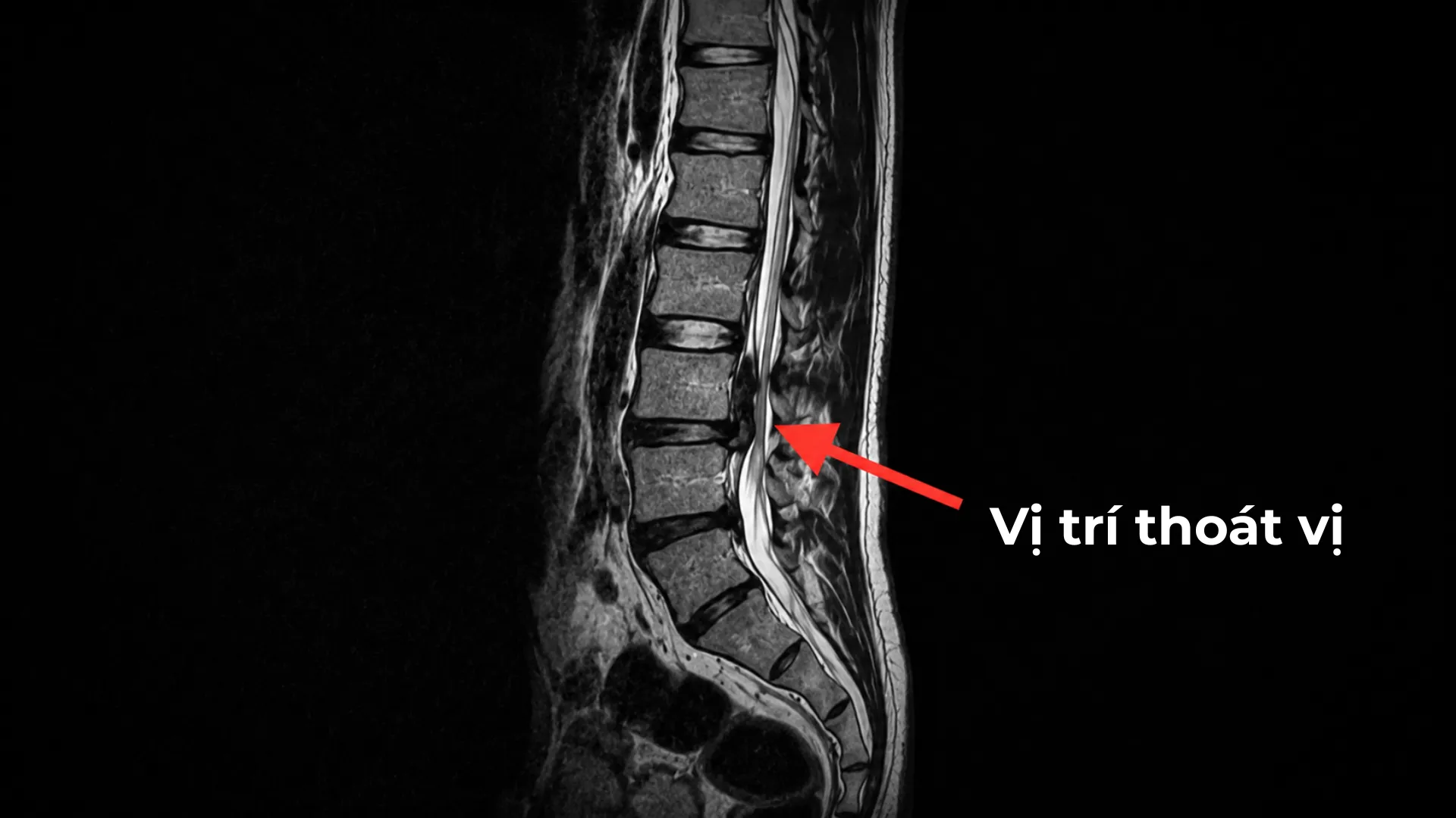 Hình ảnh MRI thoát vị đĩa đệm thắt lưng
