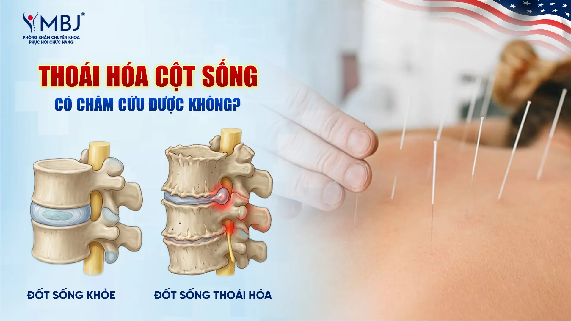 Thoái hoá cột sống có châm cứu được không?