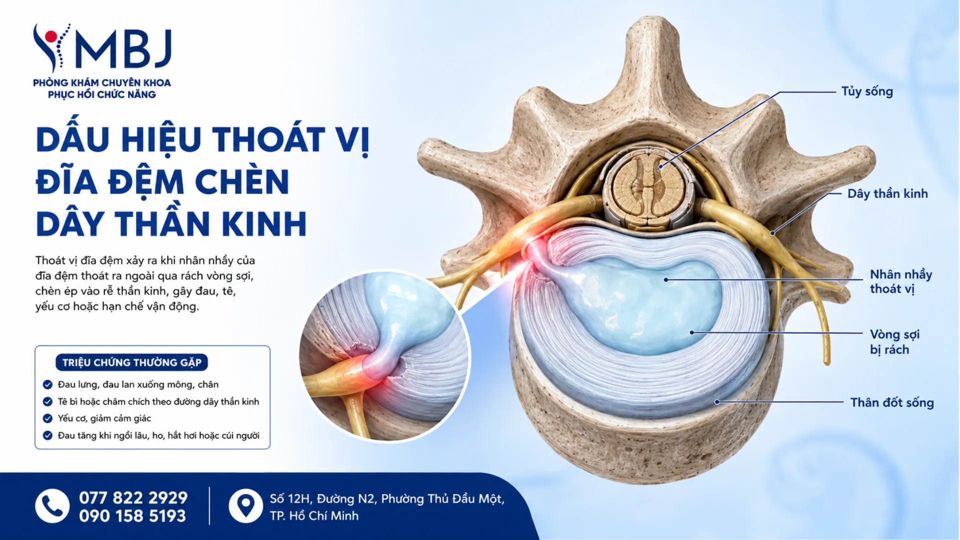 Thoát vị đĩa đệm chèn dây thần kinh là gì? Triệu chứng và cách điều trị