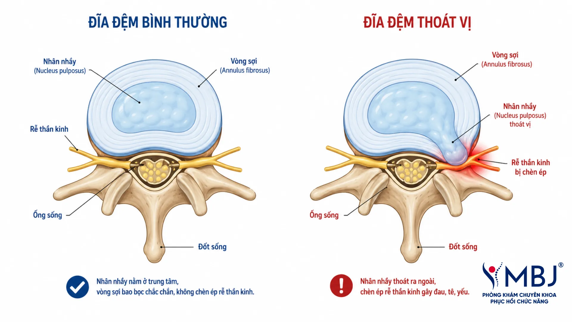 Sơ đồ cắt ngang cột sống so sánh đĩa đệm bình thường và đĩa đệm thoát vị chèn ép rễ thần kinh