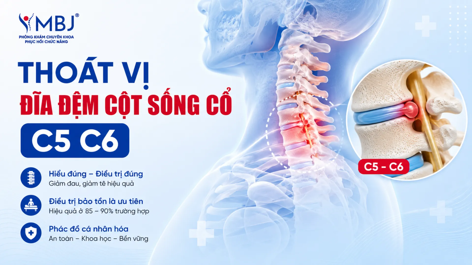 Tìm hiểu về bệnh lý thoát vị đĩa đệm cột sống cổ C5 C6