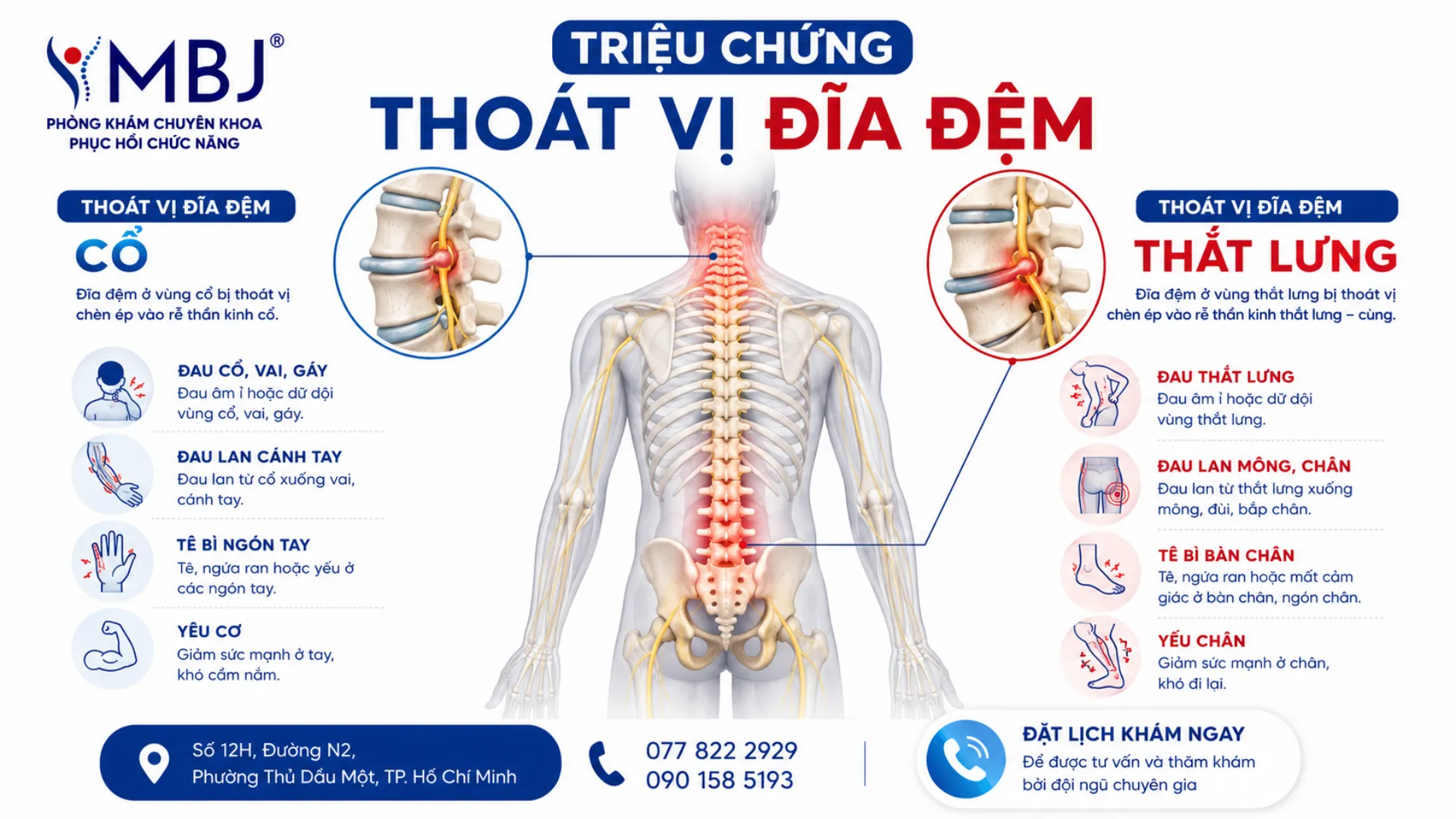 Triệu chứng thoát vị đĩa đệm theo vị trí cần chẩn đoán