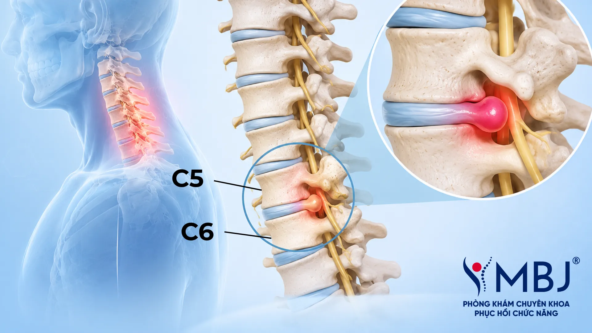 Vị trí chèn ép C5 C6 trên cột sống