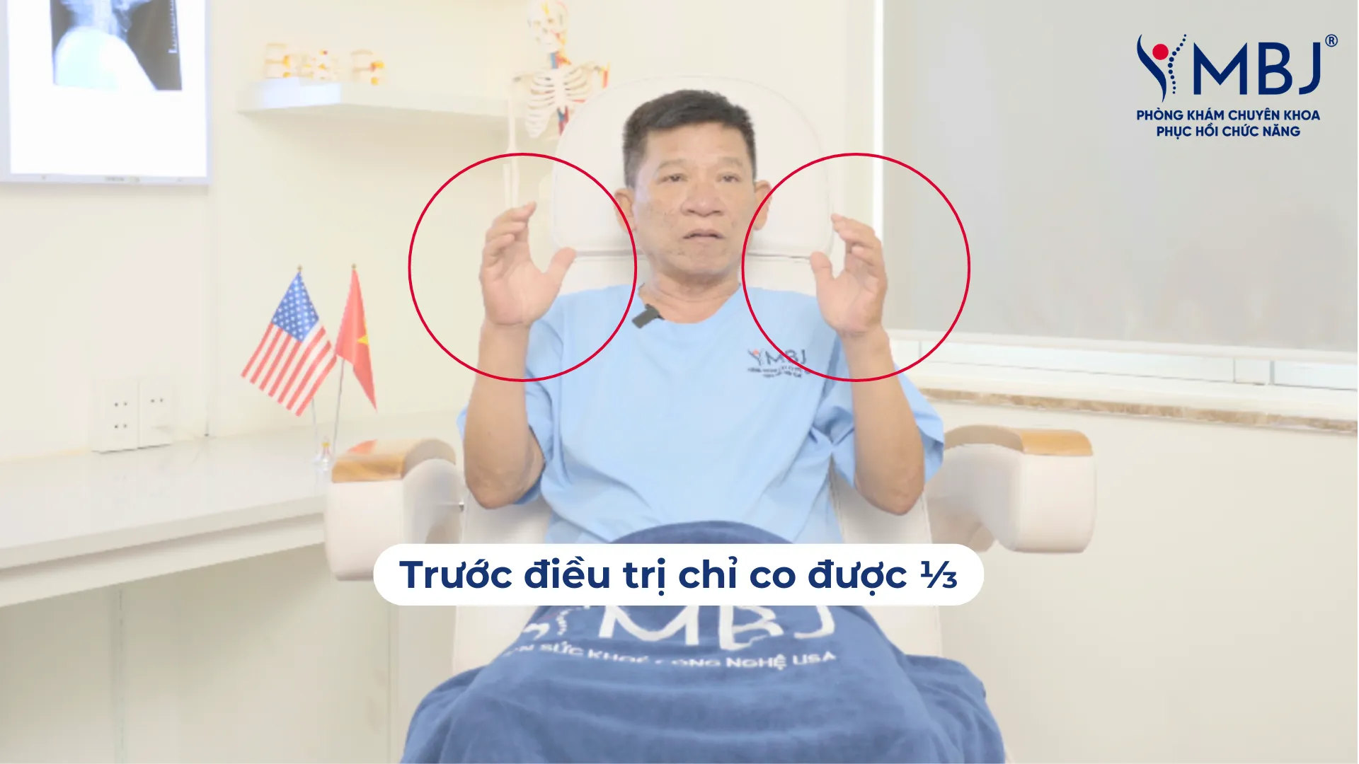 Bàn tay bị viêm khớp ngón tay chỉ co được một phần ba tầm vận động bình thường