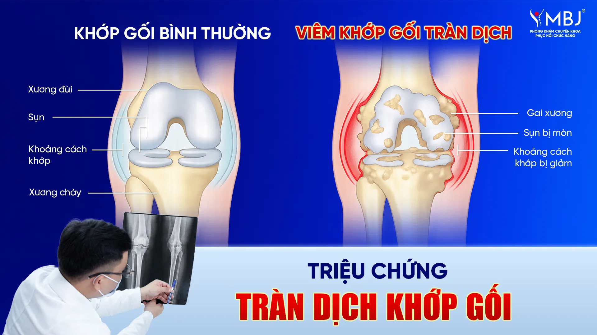 Triệu chứng tràn dịch khớp gối