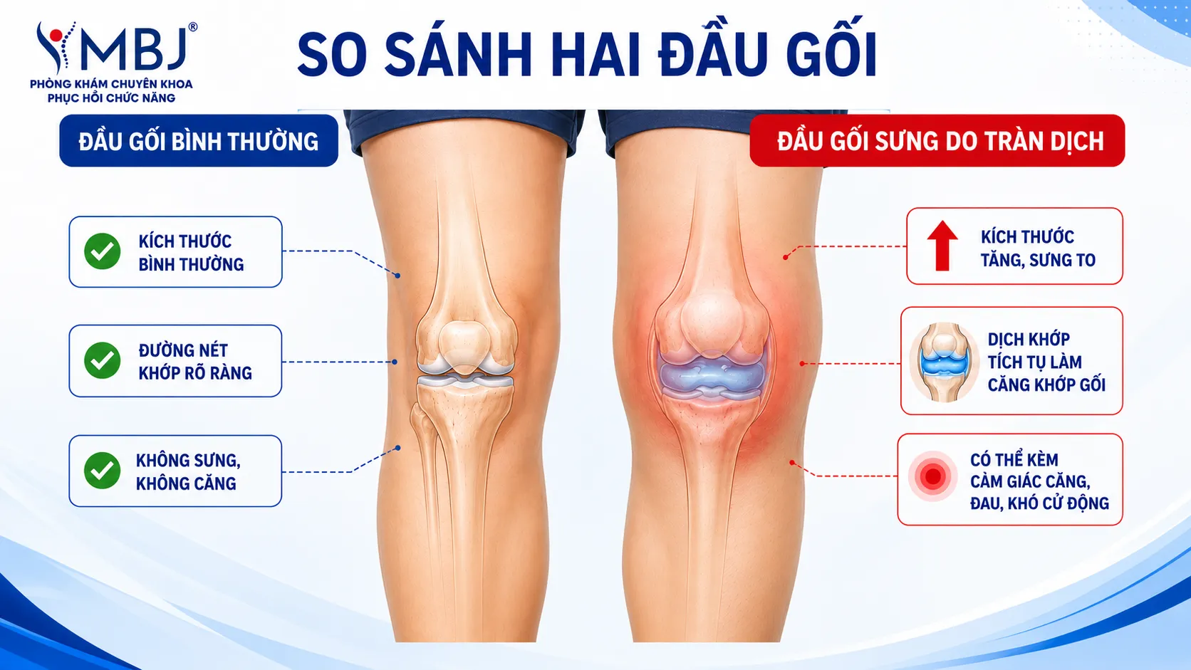 Triệu chứng viêm khớp gối tràn dịch không nên chủ quan