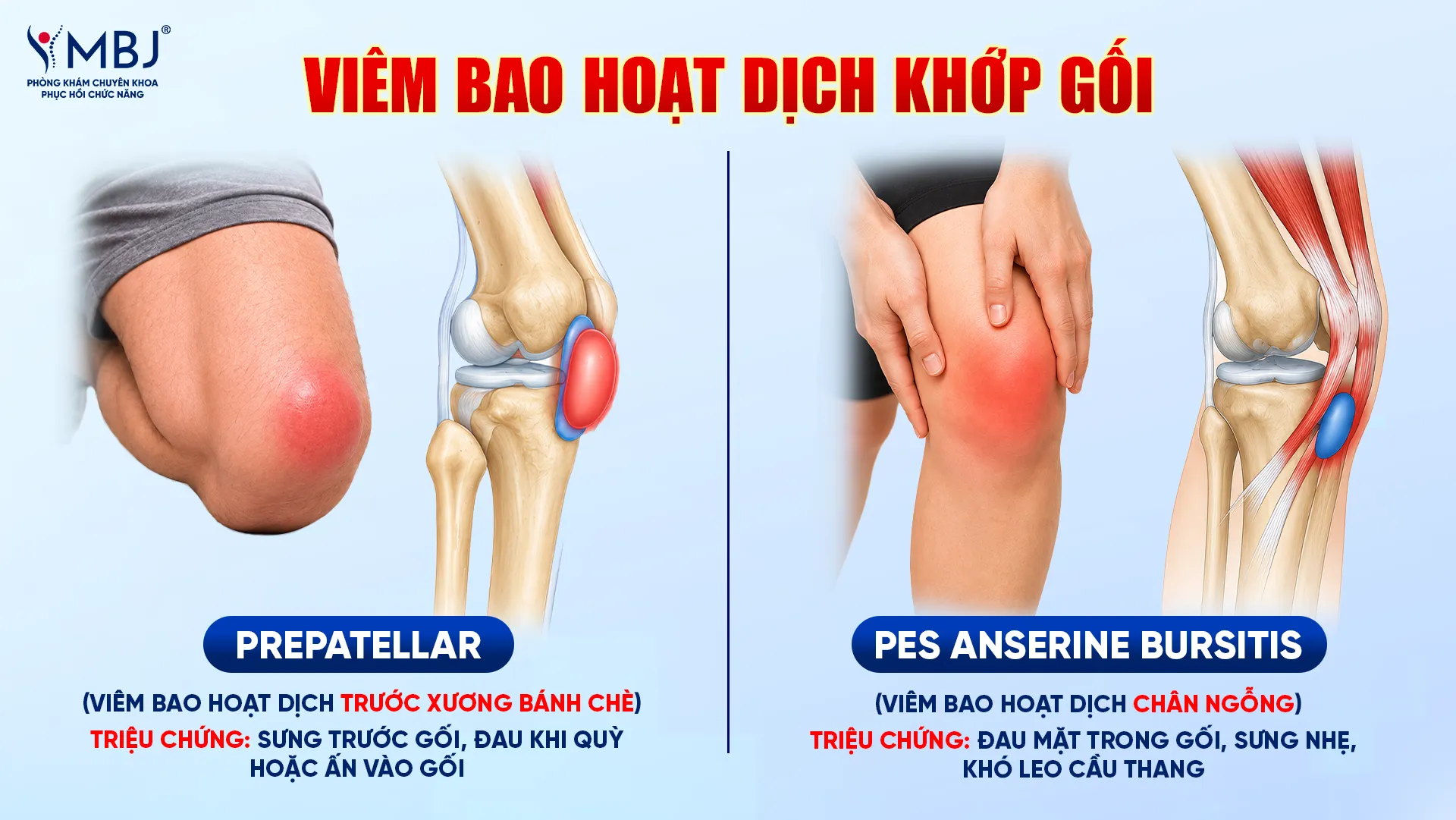Vị trí viêm bao hoạt dịch khớp gối thường gặp