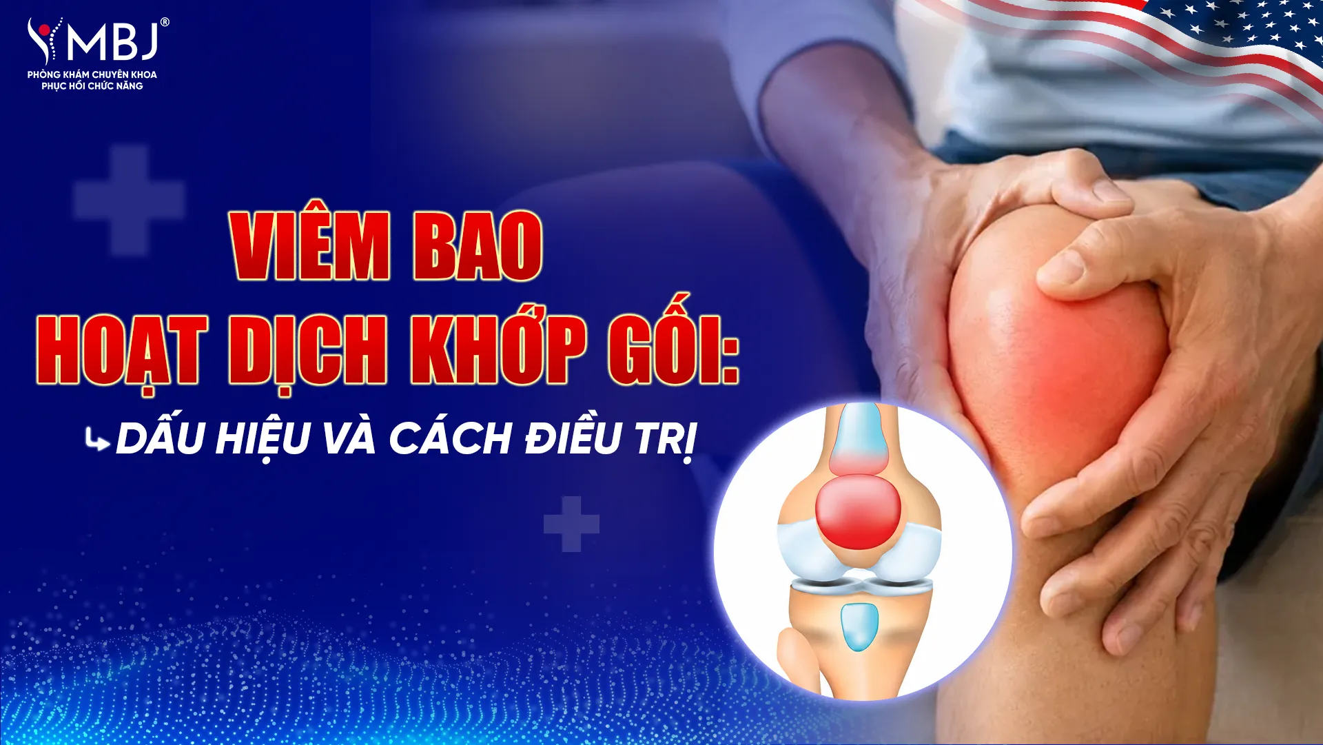 Viêm bao hoạt dịch khớp gối
