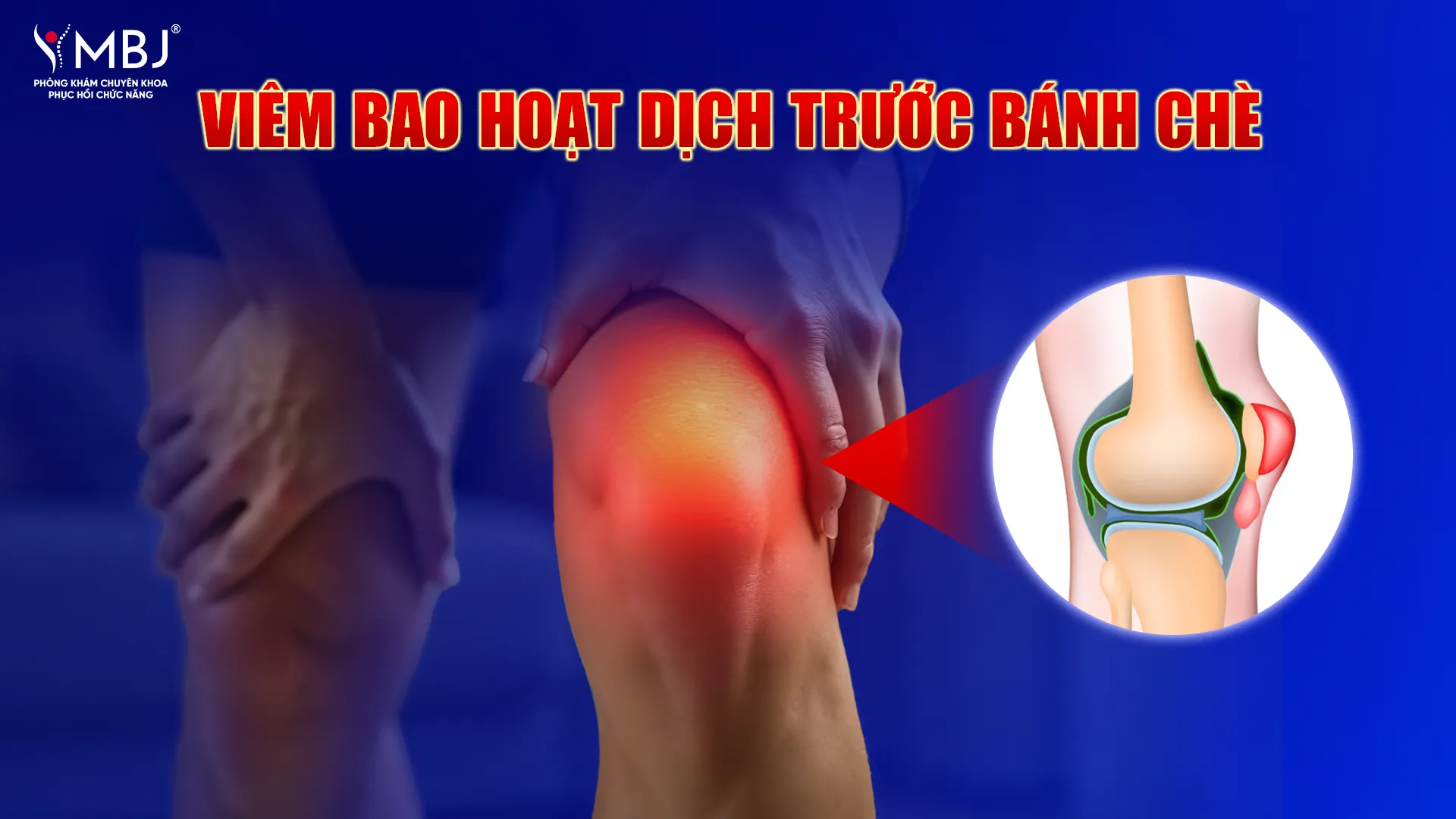 Viêm bao hoạt dịch trước bánh chè