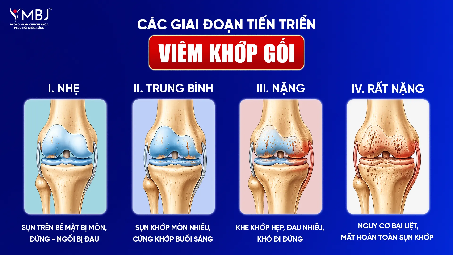 Các giai đoạn tiến triển của viêm khớp gối