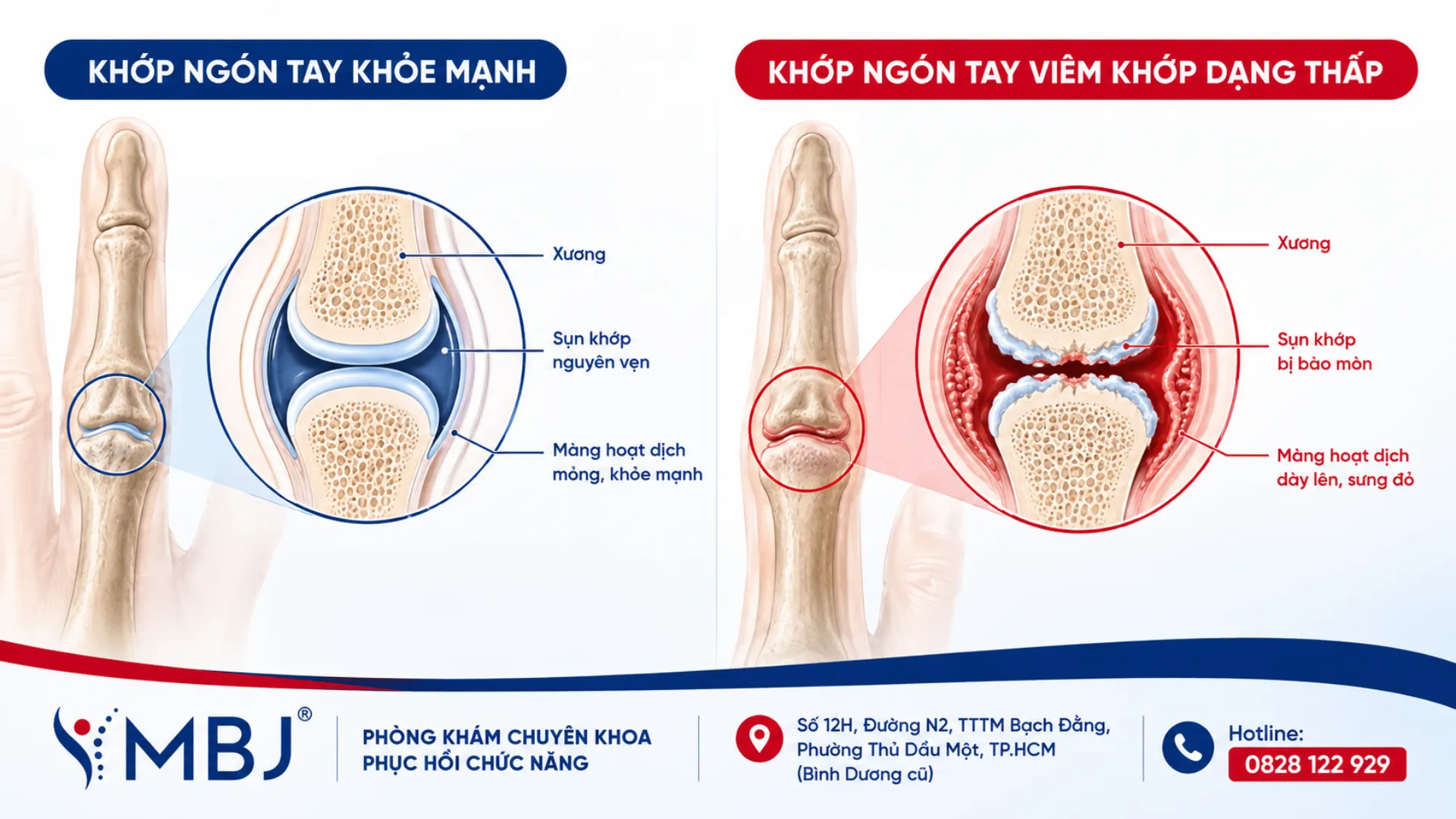So sánh khớp khỏe mạnh và khớp viêm dạng thấp có màng hoạt dịch dày lên