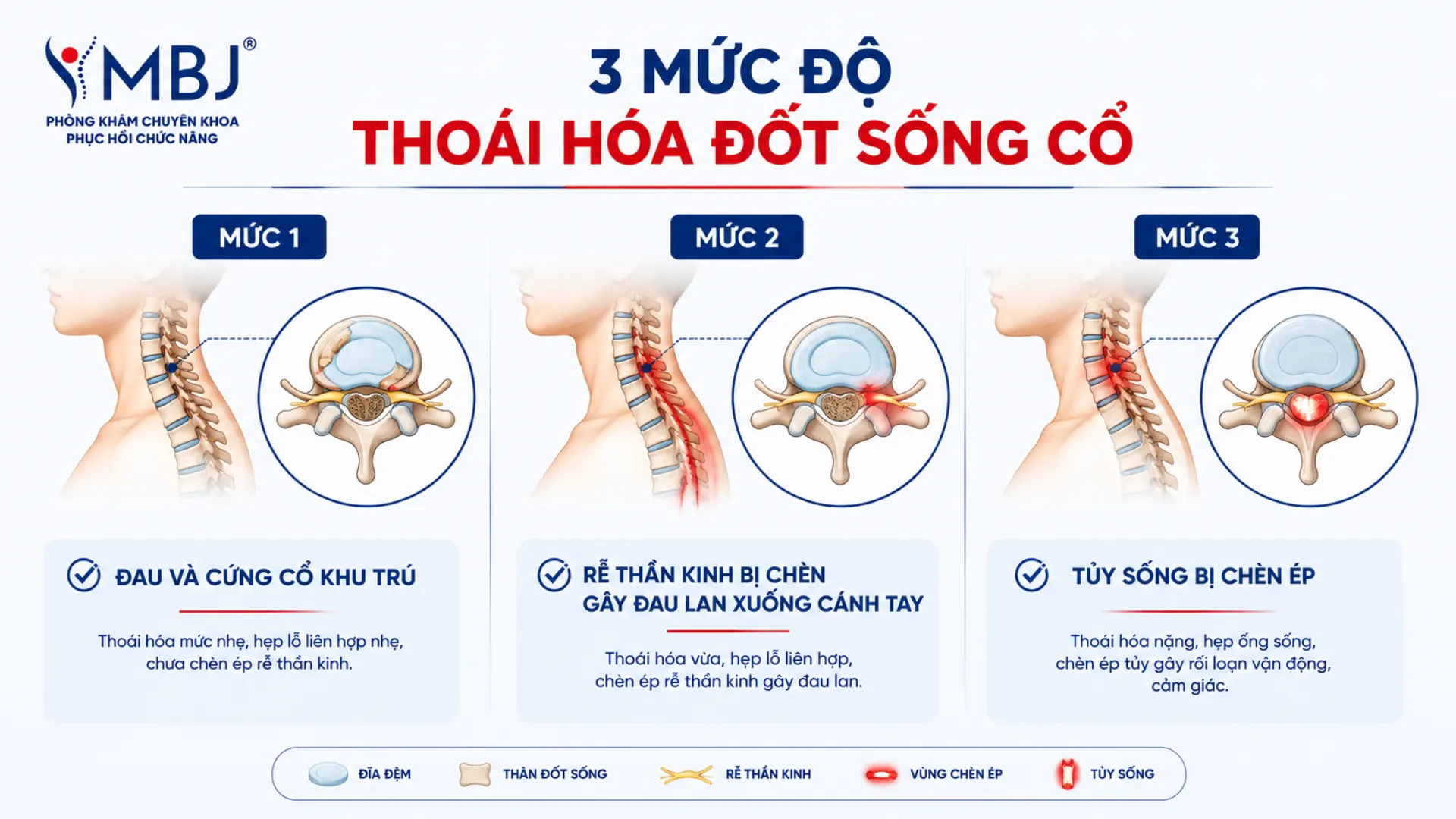 3 mức độ thoái hóa đốt sống cổ từ đau cổ tới chèn ép tủy