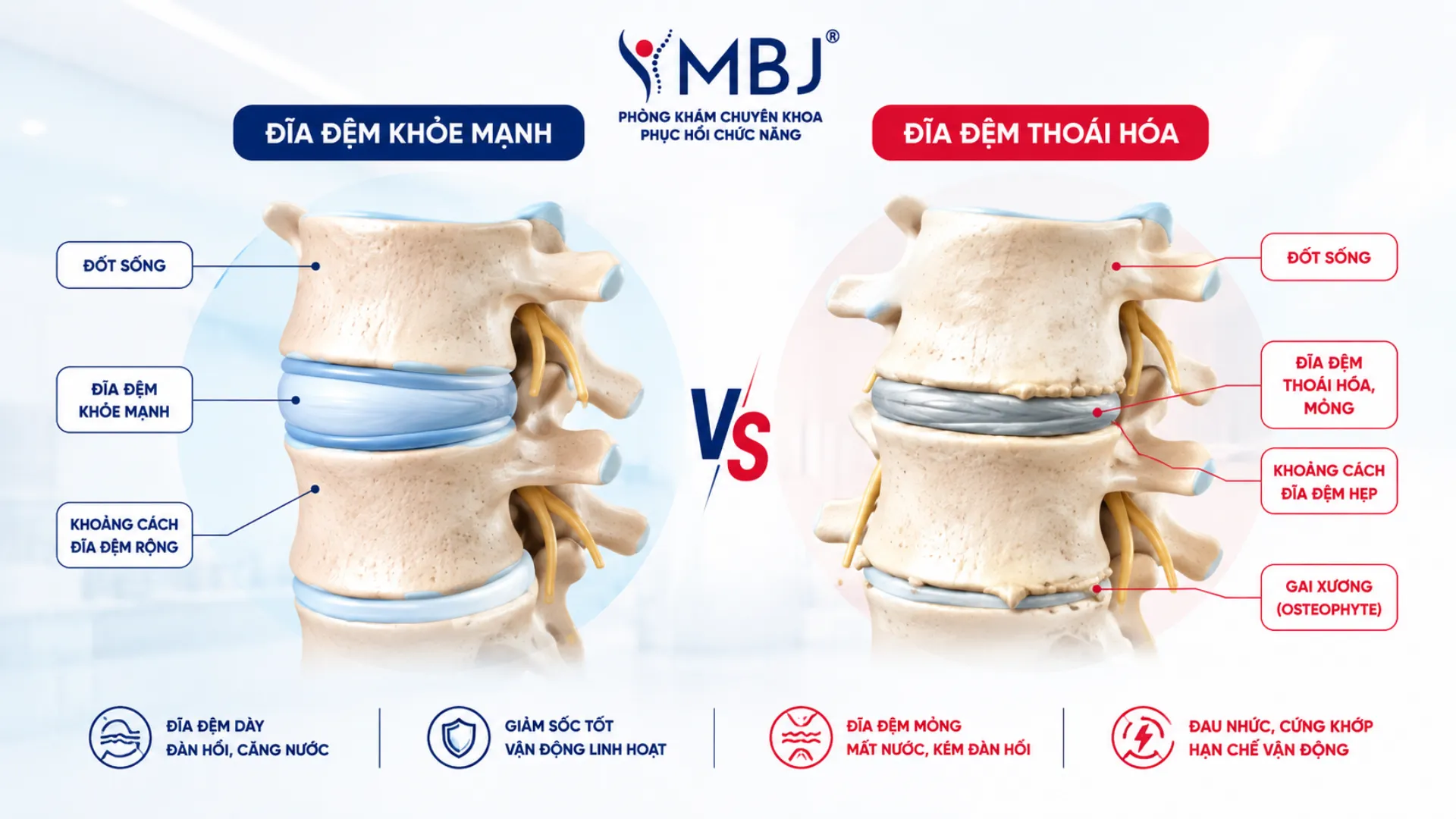 Sơ đồ so sánh đĩa đệm khỏe và đĩa đệm thoái hóa mất nước kèm gai xương
