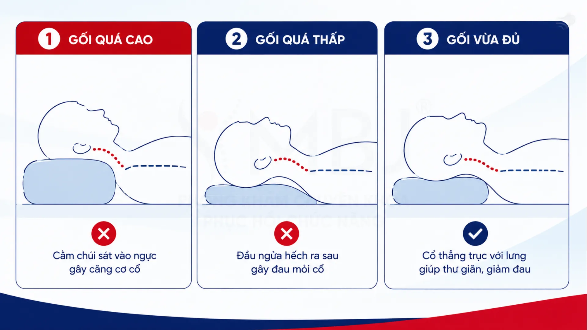 Ba mức độ cao gối khiến cằm chúi vào ngực cổ ngửa ra sau và cổ thẳng trục
