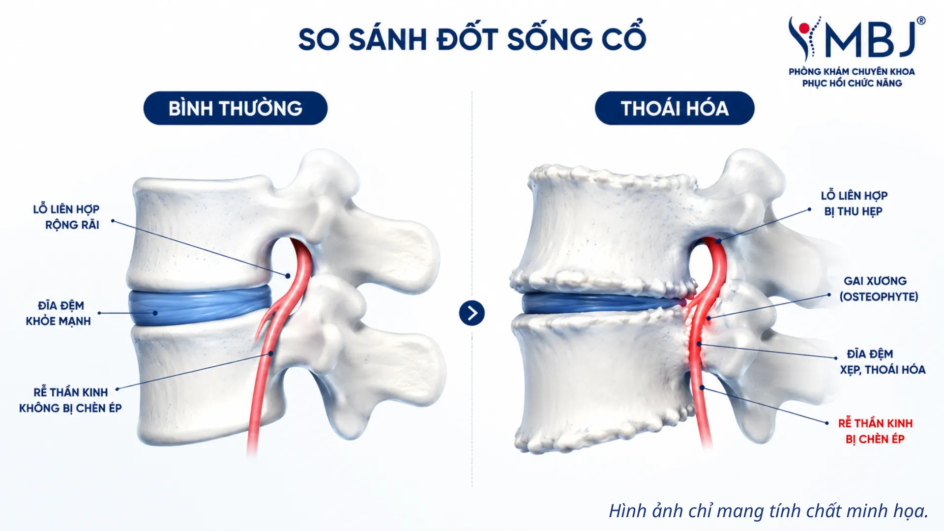 Gai xương làm hẹp lỗ liên hợp và chèn ép rễ thần kinh cột sống cổ