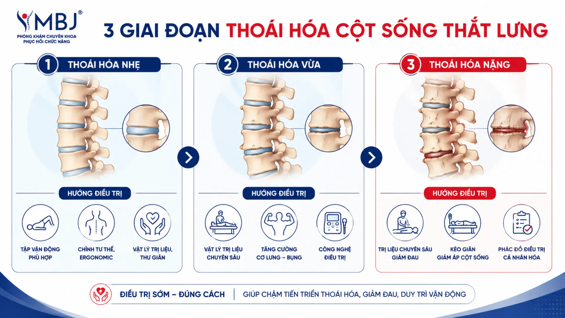 Sơ đồ ba giai đoạn thoái hóa cột sống thắt lưng nhẹ vừa nặng và hướng điều trị tương ứng