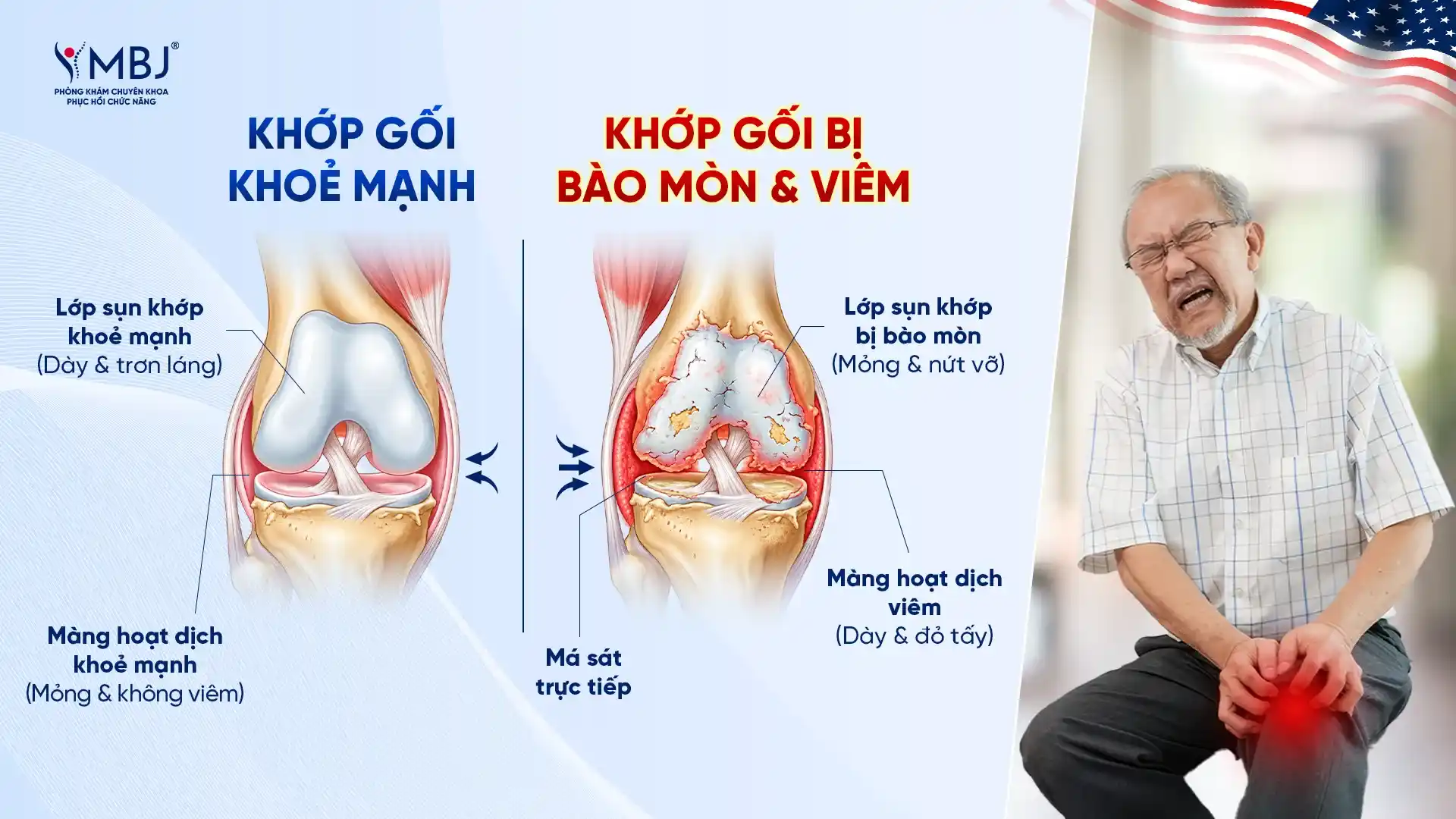 So sánh khớp gối khỏe mạnh và khớp gối bị viêm