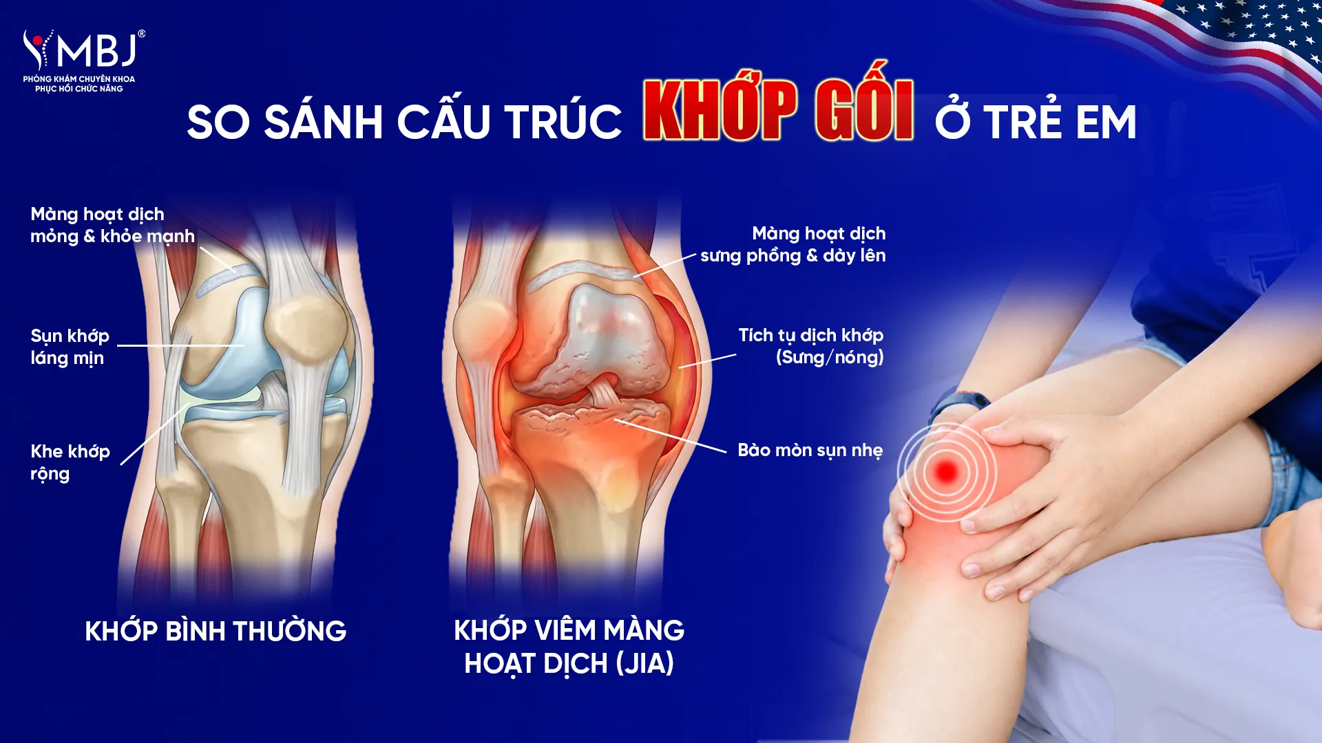 Khớp gối viêm ở trẻ với khớp bình thường