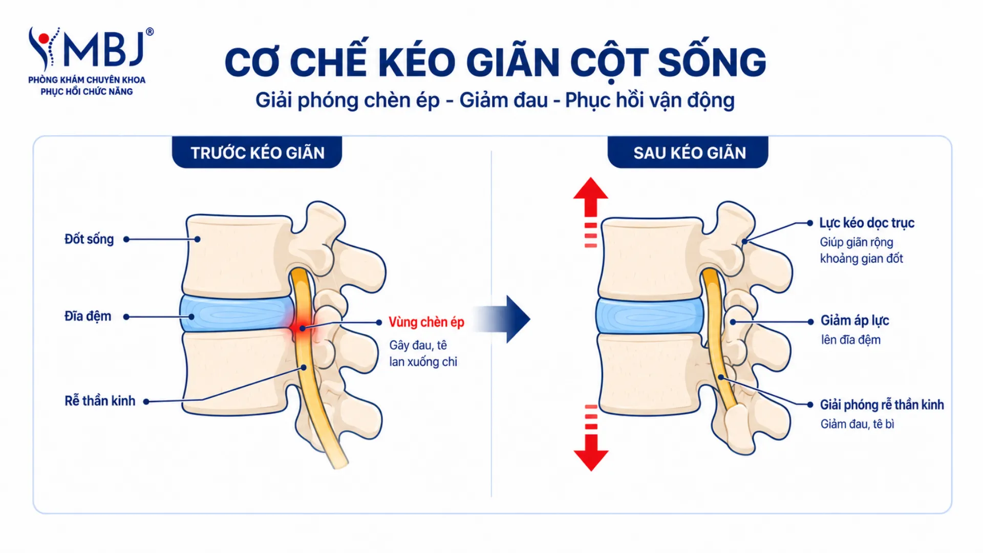 Sơ đồ cơ chế kéo giãn cột sống tạo áp lực âm giải phóng chèn ép rễ thần kinh