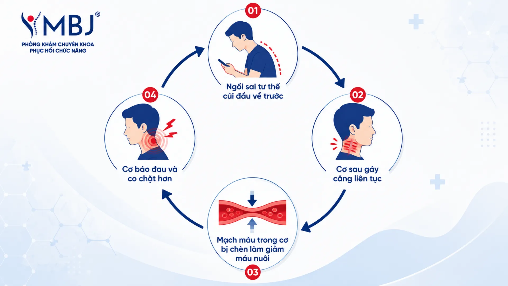 Sơ đồ vòng xoáy sai tư thế làm co cứng cơ cổ gáy rồi gây đau