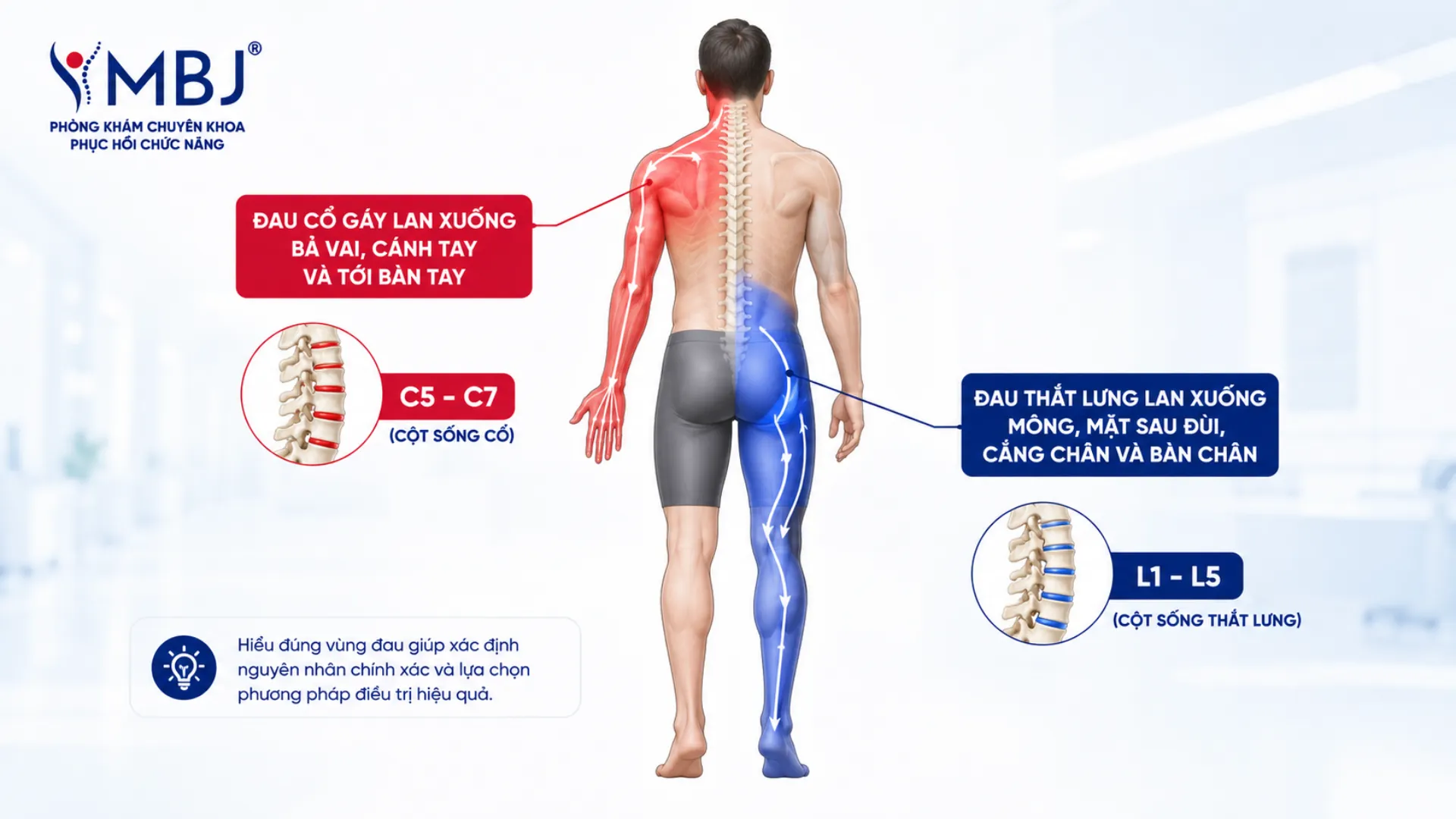 Sơ đồ vùng đau và hướng lan của thoái hóa cột sống thắt lưng và đốt sống cổ